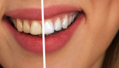 Почему темнеют зубы и как остановить этот процесс