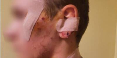 В Киевской области юноша получил травму из-за взрыва растяжки