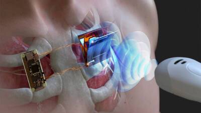 Учёные нашли способ заряжать кардиостимуляторы и другие импланты с помощью ультразвука