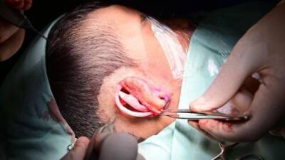 Медицинское чудо в Израиле: врачи пришили ребенку напечатанное на принтере ухо