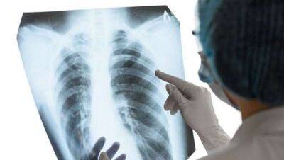 Медики назвали 6 наиболее распространенных симптомов туберкулеза