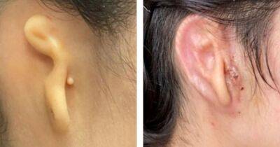 Как родное. В США пациентке пересадили ухо, выращенное из ее же тканей