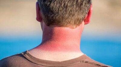 Медики назвали пять способов успокоить воспаленную кожу, если вы обгорели на солнце