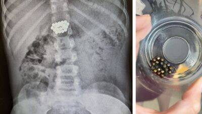 В больнице "Меир" без операции спасли 8-летнего мальчика, проглотившего 20 магнитов