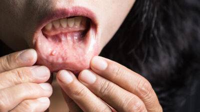 Следите за ртом: вот симптомы, которые указывают на начало серьезных болезней