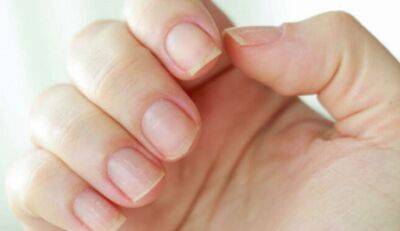 Нігті як відображення здоров'я: про які хвороби говорять зміни у нігтях