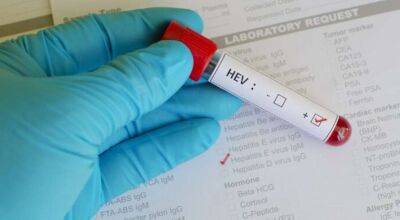 Чим небезпечний вірус гепатиту Е і як збудник обманює імунну систему, розповіли медики. - lenta.ua - Украина