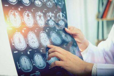 Вчені зробили важливе відкриття про хворобу Альцгеймера