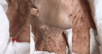 Яркий пример. Ученые показали, что будет, если наносить SPF на лицо, но не шею (фото)