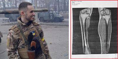 «Зачем ты оставлял ногу» — воин, раненый в Харькове, требует увольнений в МСЭК