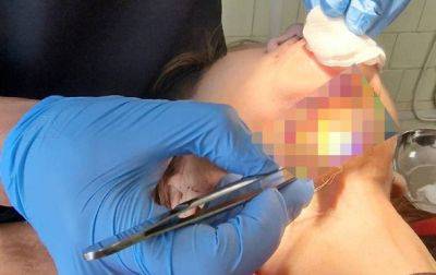 У россиянки из-за панического страха перед стоматологами сгнила челюсть