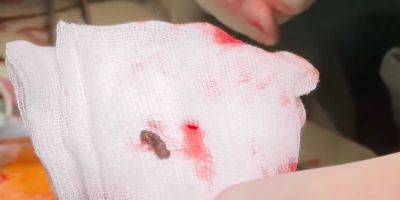 Девочка попала под минометный обстрел. В Украине врачи достали обломок российской мины из сердца ребенка — видео
