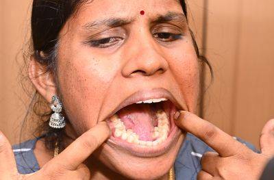 "Главное достижение в жизни": Индианка побила мировой рекорд по количеству зубов
