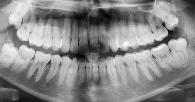 Загадка в полости рта. Стоматологи рассказали, почему у людей есть зубы мудрости