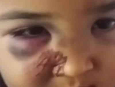 Ситуацию с ребенком, которого избил отец, взял на контроль детский омбудсман. Видео
