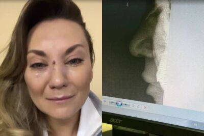 Беда с женой продюсера "Квартал 95", Анна Саливанчук разбила лицо и сломала нос: кадры из больницы
