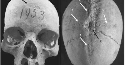 Первая трепанация в истории. Найдены останки женщины из Средневековья с отверстиями в черепе