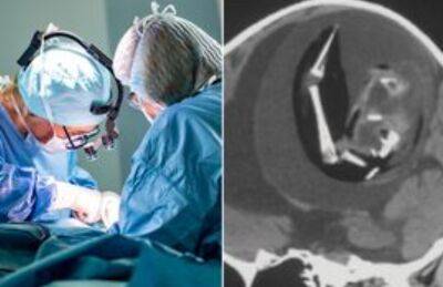Один випадок на мільярди: у однорічної дівчинки з черепа видалили плід її ж близнюка