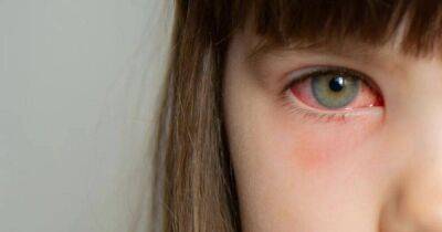 Берегите глаза. Ученые рассказали о странном симптоме нового варианта COVID-19