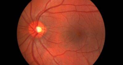 Генная терапия восстановит зрение, утерянное из-за тяжелого дегенеративного заболевания
