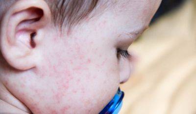 Детский инфектолог: сыпь из-за вируса Коксаки пройдет сама по себе