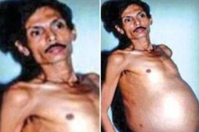 В мужчине, который выглядел беременным, 36 лет жил его близнец - akcenty.com.ua - Украина - Индия - Мумбаи