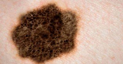 Скрытая угроза: эксперт рассказала, как вовремя раскрыть замаскированный рак кожи на вашем теле