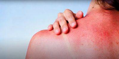 Ожоги достанут до кости: можно ли пользоваться прошлогодним защитным кремом от солнца