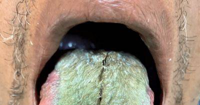Зеленый волосатый язык. Мужчина пришел к врачам с ужасающими изменениями во рту