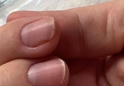 Проверьте свои ногти на руках: простые симптомы, которые расскажут о затаившемся раке
