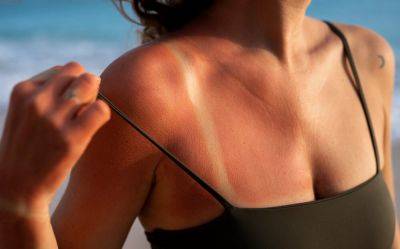 Дерматолог рассказала, почему нельзя сдирать обгоревшую на солнце кожу