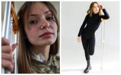 "Я очень расстроилась из-за того, что выжила": Героиня из Одессы рассказала, как пережила тяжелое ранение