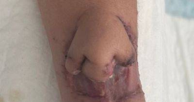 Необычная операция. Хирурги напечатали нос на 3D-принтере и прикрепили его к руке пациентки (фото)