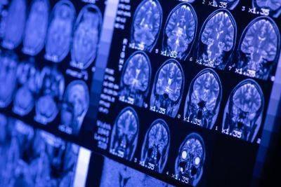 Искусственный интеллект обучили находить рак мозга