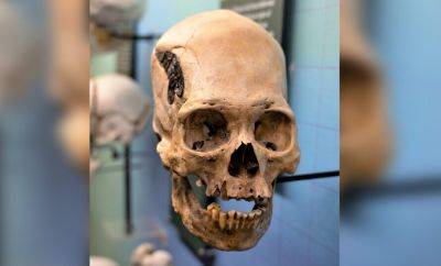 В Перу археологи нашли череп с металлическим имплантом