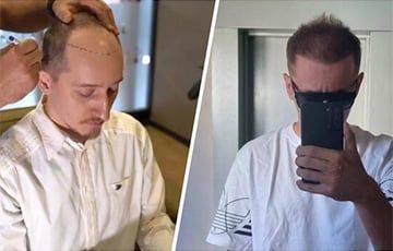Белорус заплатил $2,5 тысячи за пересадку волос в Стамбуле