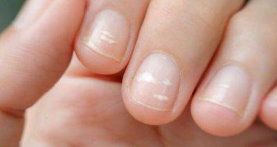Белые точки на ногтях: что они значат и как с ними бороться