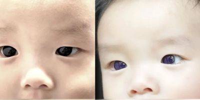 Эффектная побочка. Препарат против коронавируса изменил цвет глаз ребенка на синий