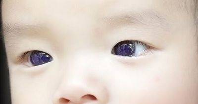 В Таиланде у кареглазого младенца после лечения от COVID-19 фавипиравиром посинели глаза