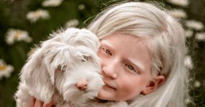 Как живет уникальная девочка-альбинос с чрезмерно подвижными глазами (фото, видео) - focus.ua - США - Украина