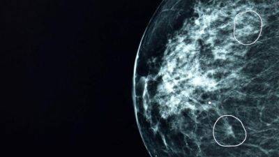 В Британии ИИ помог обнаружить случаи рака груди, пропущенные врачами